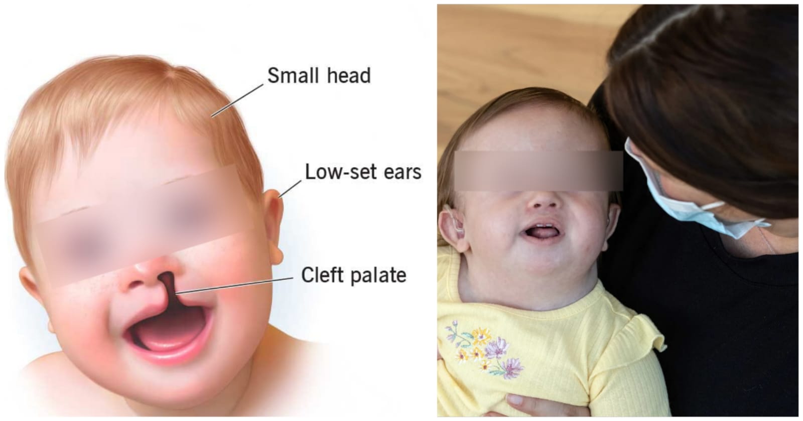 ট্রাইসোমি অসুখ