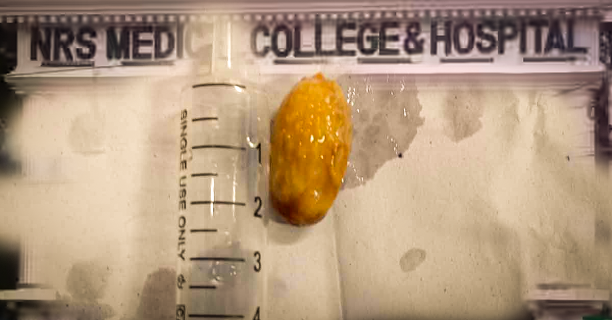 নীলরতন সরকার মেডিক্যাল কলেজ ও হাসপাতাল-এ ফাইবার-অপটিক ব্রঙ্কোস্কোপিতে কিশোরীর প্রাণরক্ষা